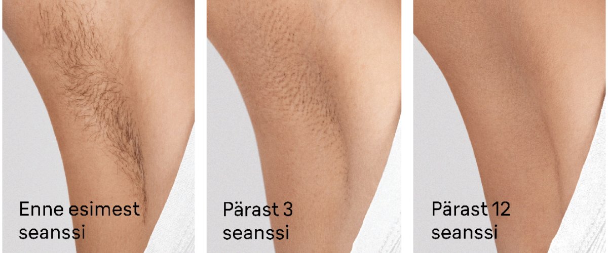 Fotoepilaatori tulemused enne ja pärast kasutamist