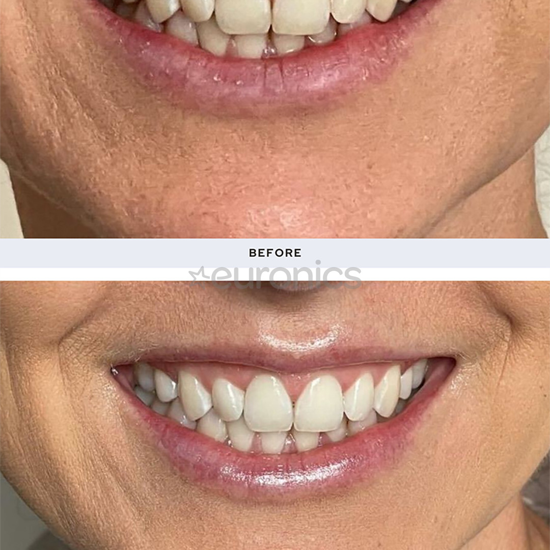 Spotlight - LED-hammaste valgendussüsteemi täitekomplekt